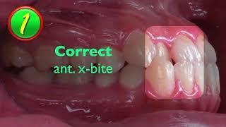 Correcting Anterior Crossbite for Patients with Extraction Space｜【Chris Chang Ortho】CC438