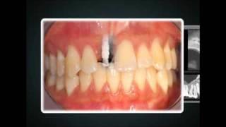 Replacing Front Tooth With Dental Implant