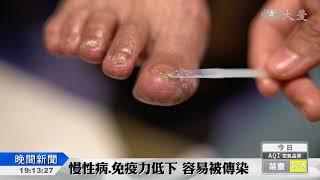 共用指甲刀 家人間傳染灰指甲