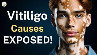 Causes for Vitiligo: Shocking Truth Revealed by Dr. Sandeep Bhasin! | Care Well Medical Centre