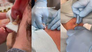 Popping huge blackheads and Giant Pimples - Best Pimple Popping Videos #178