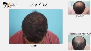 2000 Grafts Hair Transplant Surgery Result after 6 Months