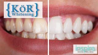 SUPER EFFECTIVE Teeth Whitening Solution | Kör Whitening