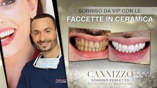 Cannizzo Studio - Faccette in ceramica Prima e Dopo