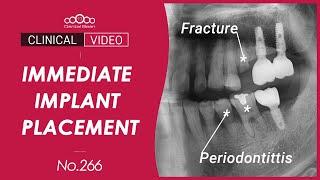 #25, 35, 36 Immediate implant placement after extraction - [Dr.Cho Yongseok]