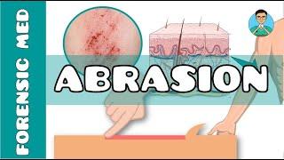 Abrasion | What are the causes of abrasion? | What are types of abrasion