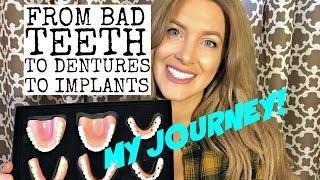 Bad teeth, dentures, and dental implants: My Story