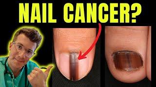 Cancer of the nail? Doctor O'Donovan explains Acral Lentiginous Melanoma and Subungual Melanoma