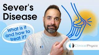 Severs disease | Expert Physio Guide