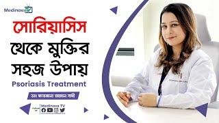 সোরিয়াসিস থেকে মুক্তির সহজ উপায় || Psoriasis Treatment || Dr Farzana Rahman Shathi