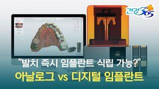 디지털 임플란트 바로 알기 | 발치 즉시 임플란트가 가능하다고? 아날로그 vs 디지털 임플란트 비교!