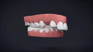 Invisalign® Treatment with Manidublar Advancement