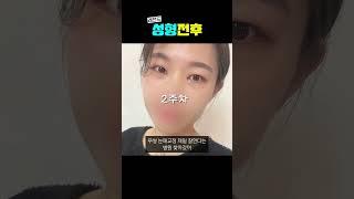 무쌍성형, 다 같은 무쌍이 아닙니다  #인스타성형외과 #강남성형#무쌍 #무쌍눈매교정 #무쌍성형 #트임성형 #눈매교정