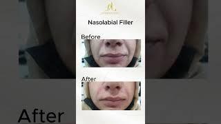 Nasolabial Filler | Dr Aftab afzal | Aesthetics Lounge Isb #beauty #filler #islamabad