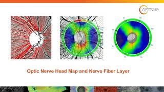 OCT Interpretation in the Diagnosis and Management of Glaucoma