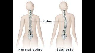 Сколиоз. Этиология заболевания. Работа через мышцы антагонисты. Балансйога