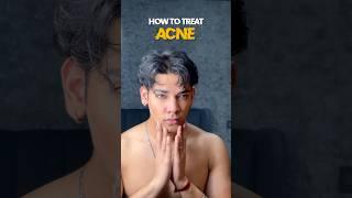 How to treat acne  #acne #pimplefree #skincareroutine