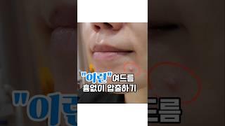 "이런" 여드름 흉없이 압출하기