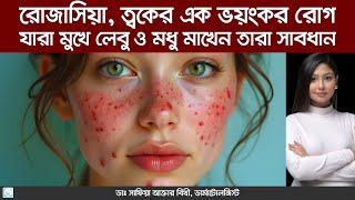 রোজাসিয়া হলে কী করবেন এবং কী করবেন না | rosacea treatment - Dr. Safia Akter Bithy