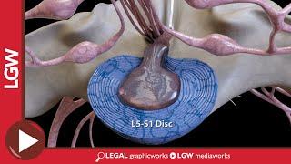 L4 L5 and L5 S1 Microdiscectomy