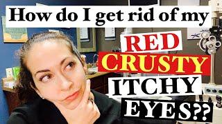 Blepharitis | 2 Easy steps to banish red, crusty, itchy eyes | The Eye Surgeon