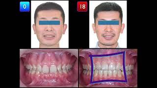 Solving Deep Bite with Retroclined Upper Incisors & U7 Crossbite｜【Chris Chang Ortho】CC773