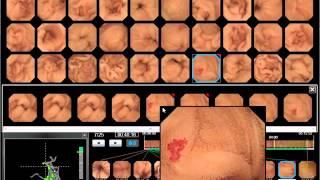 WEO Video Capsule Endoscopy (VCE) Library: clinical case 51