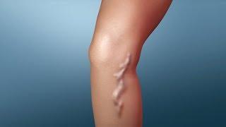 Treatment for Varicose Veins | Nucleus Health