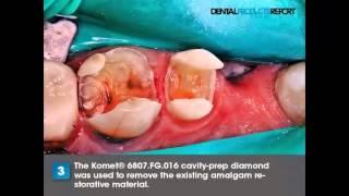 How To Provide Multi-Disciplinary Dentistry Using Komet's Crown Kit