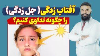 آفتاب زدگی(جل‌زدگی) را چگونه تداوی کنیم؟| دکتور قیس نیکزاد