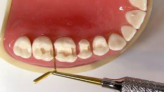 Dr. Nejad's Method for Restoring a Quadrant