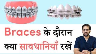 दांतों पर braces के दौरान यह करें | Teeth Braces Instruction in Indore | Seraphic Dental