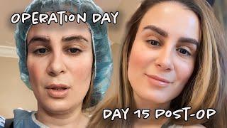 Day 1 through 15 Eyebrow Hair Transplant progression | Part 3