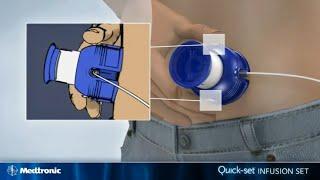 Introduction to Quickset | Medtronic Diabetes India
