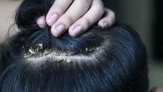 Dandruff scratching removal on head using black combing#349