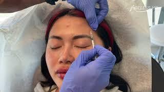 Botox / Dysport treatment - Ageless MD