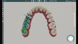 Contacts Tool for Aligner Treatment Planning