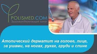 Атопический дерматит у детей и взрослых на голове, лице, за ушами, на ногах, руках, груди и спине