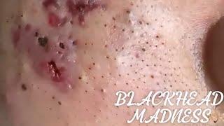 Relaxing Blackheads Removal #45