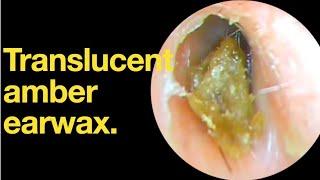 Translucent amber earwax. |ear wax removal | ear cleaning | ASMR | relaxation | relax