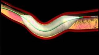 Balloon Angioplasty and Stenting Animation