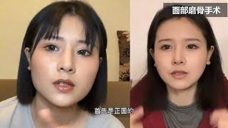 削骨磨骨手术，90后小姐姐分享整容手术全纪录，变美恢复不容易！