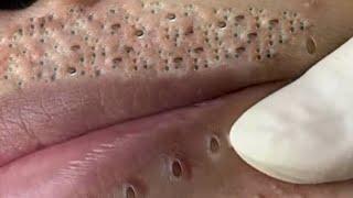 Big Cystic Acne Blackheads Extraction Blackheads & Milia, Whiteheads Removal Pimple Popping # 1241