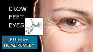 Crow Feet Eyes | Crow के पांव जैसे WRINKLES at corner of the Eyes - what, Why & Treatment.