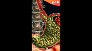 What Causes Acid Reflux? | 3D Animation #Shorts