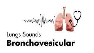 Bronchovesicular Breath Sounds - Lung Sounds - MEDZCOOL