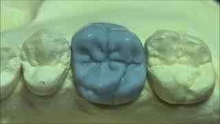 Live wax up - Upper 1st molar wax up( full )