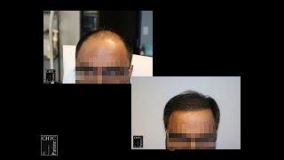 Before and After Photos of FUE Hair Transplant with 2,800 Grafts by CHICAGO HAIR TRANSPLANT CLINIC