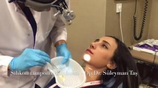 Removing Silicone Tampons After Rhinoplasty