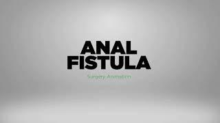 Laser Anal Fistula Treatment Malaysia | Minimally Invasive, No Incontinence, Fast Recovery